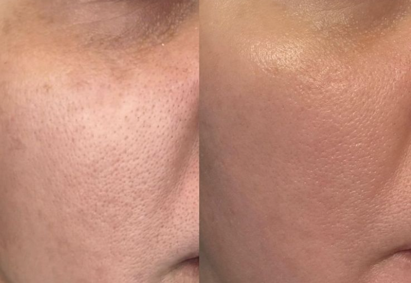 Laser Nd YAG là công nghệ laser thẩm mỹ phổ biến trên thị trường.