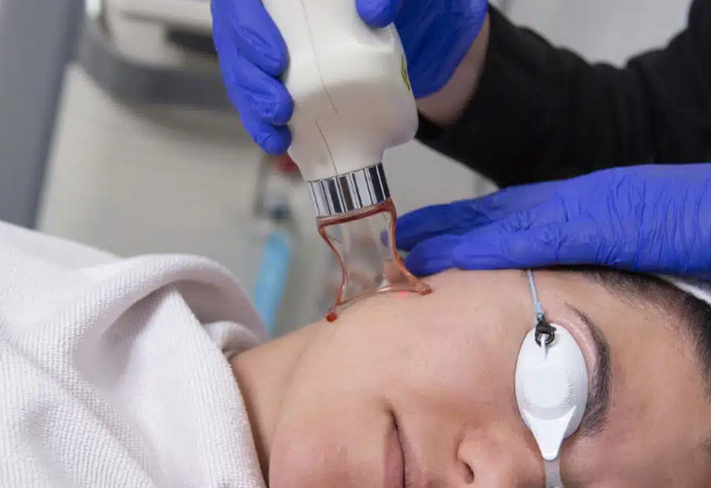 Laser CO2 Fractional: Cơ chế, tác dụng và lưu ý sử dụng an toàn