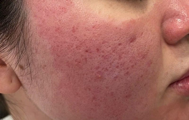 Laser CO2 Fractional: Cơ chế, tác dụng và lưu ý sử dụng an toàn