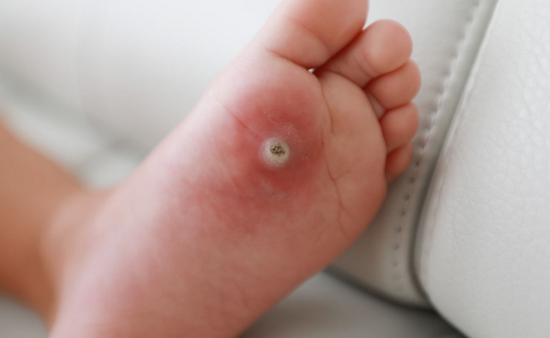 Laser CO2: Cơ chế, tác dụng và lưu ý an toàn