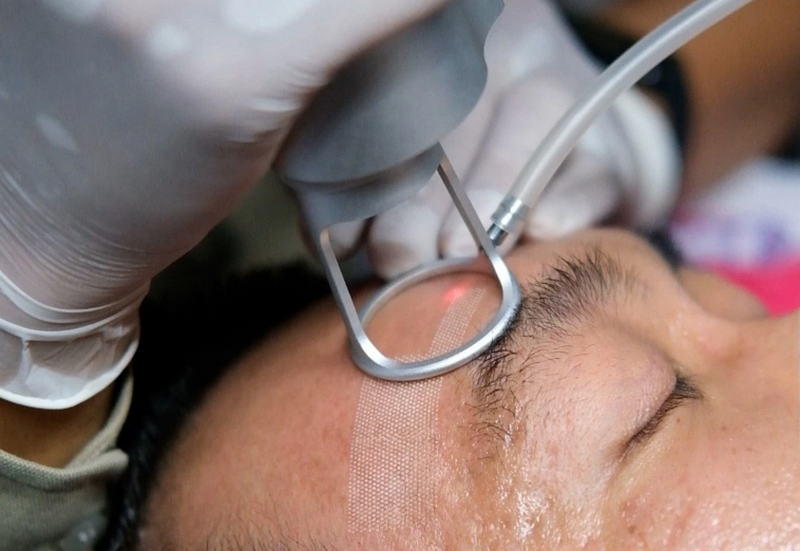 Laser CO2: Cơ chế, tác dụng và lưu ý an toàn