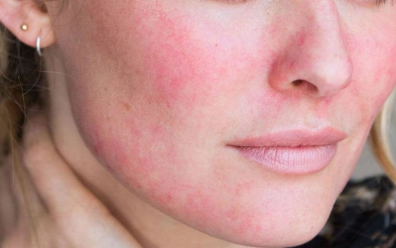 Chăm sóc da sau laser CO2, những điều nên và không nên làm