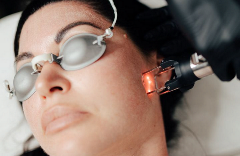 Laser Fractional là gì? Công dụng, cơ chế, khác gì với laser thường?