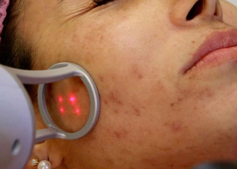 Laser Fractional là gì? Cơ chế và cách sử dụng an toàn