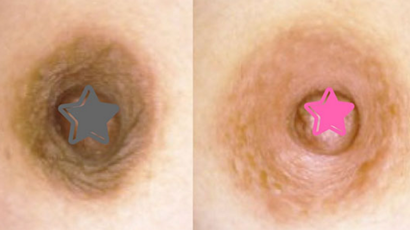 Núm vú thâm: Nguyên nhân và cách xử lý