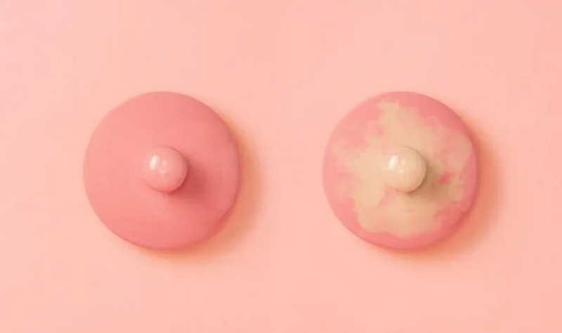 Núm vú thâm: Nguyên nhân và cách xử lý