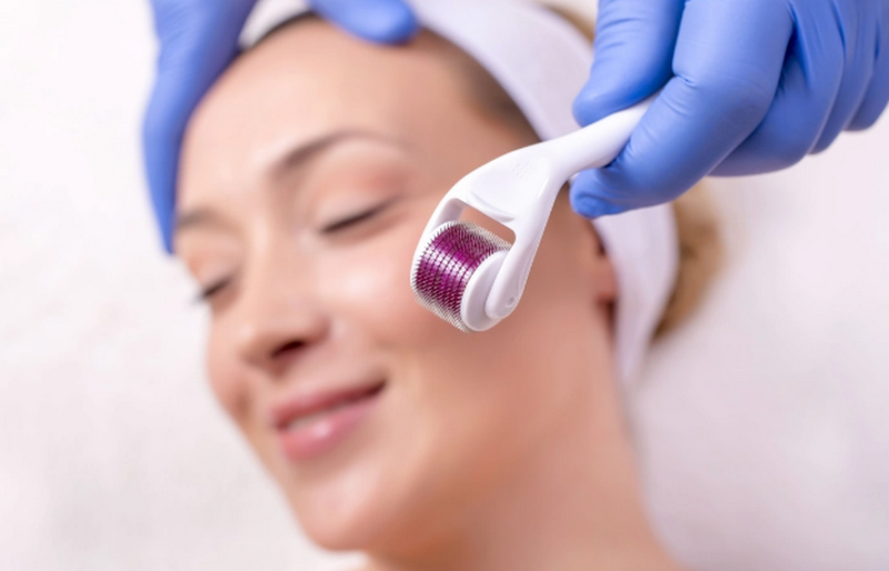 Lăn kim trị sẹo rỗ là gì? Cơ chế, hiệu quả và những điều cần biết