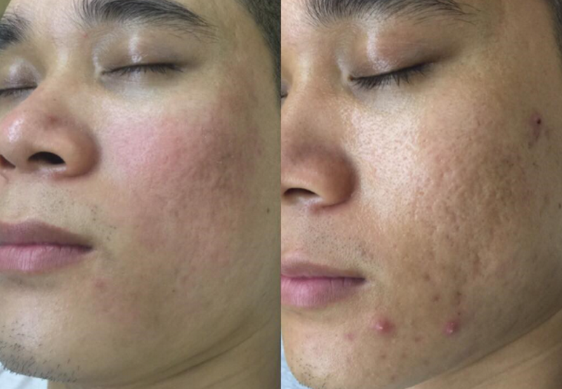 Lăn kim là một trong những phương pháp điều trị sẹo rỗ (sẹo lõm)