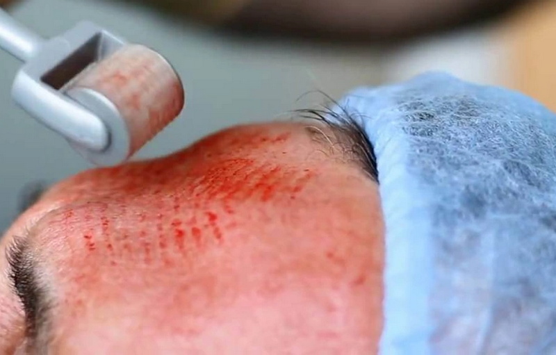 Lăn kim là một trong những phương pháp điều trị sẹo rỗ (sẹo lõm)