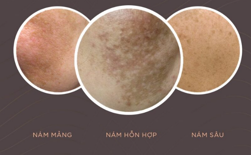 Lăn kim trị nám có tốt không? Có nên làm không?