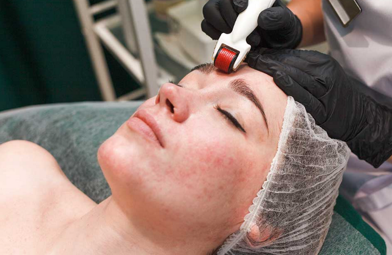 Lăn kim trị mụn như thế nào? Cơ chế và quy trình kỹ thuật