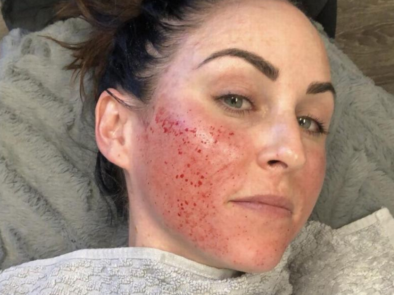 Chăm sóc da sau lăn kim giúp da phục hồi nhanh và hạn chế biến chứng