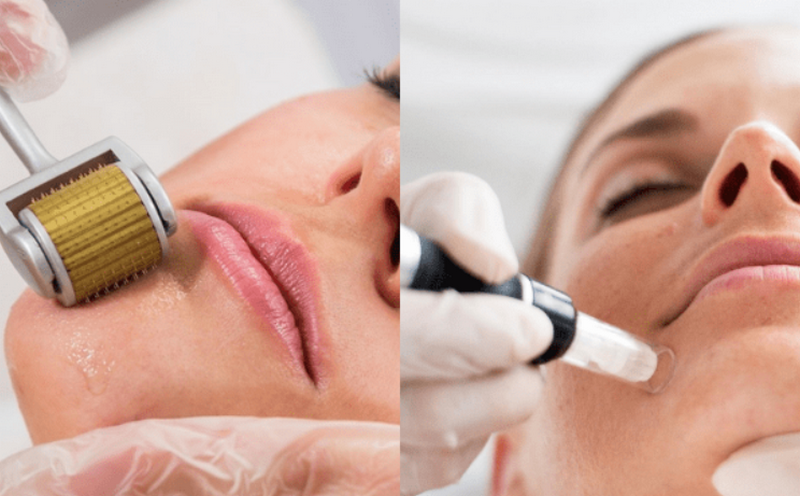 Chi phí lăn kim bao nhiêu tiền? 