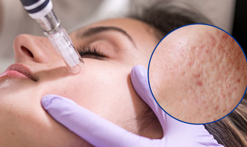 Chi phí lăn kim bao nhiêu tiền? Bảng giá và các yếu tố ảnh hưởng