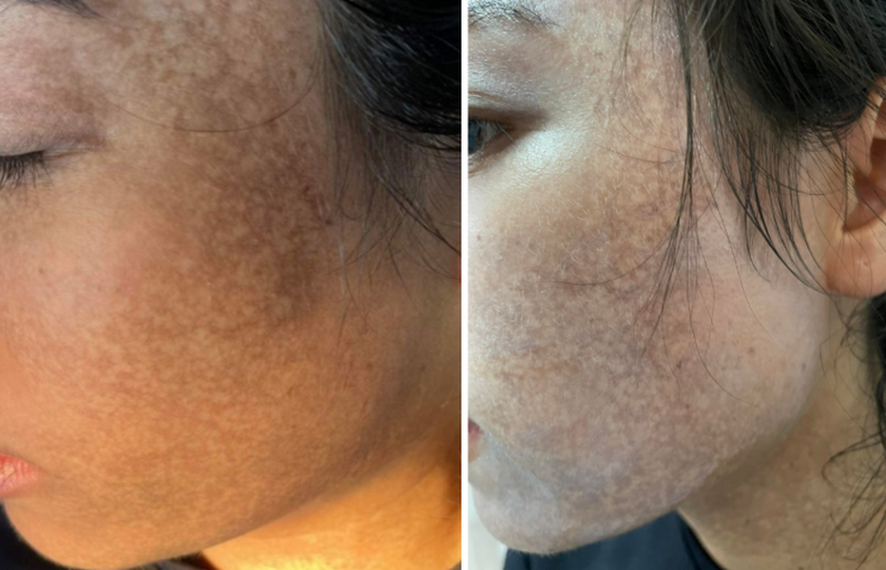 Biến chứng lăn kim: Nguyên nhân, dấu hiệu và cách xử lý an toàn