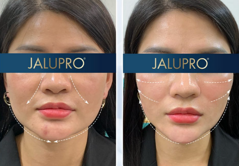 Tiêm Jalupro là gì? Quy trình, hiệu quả và những lưu ý trước khi tiêm