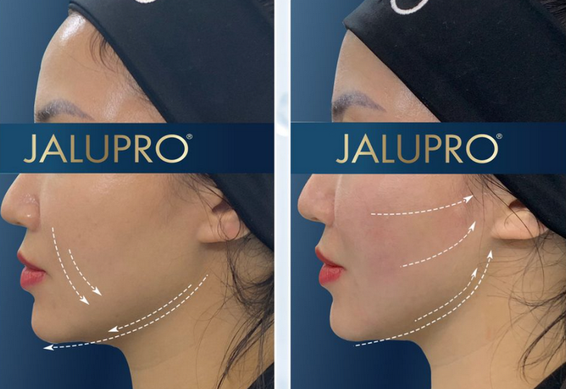 Tiêm BAP Jalupro là gì? Có khác gì meso và filler không