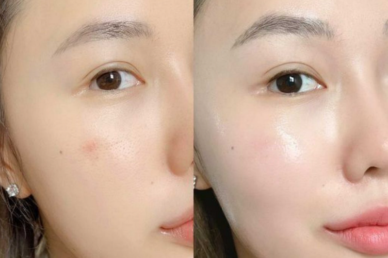 Tiêm BAP Jalupro giá bao nhiêu? Các yếu tố ảnh hưởng đến chi phí.