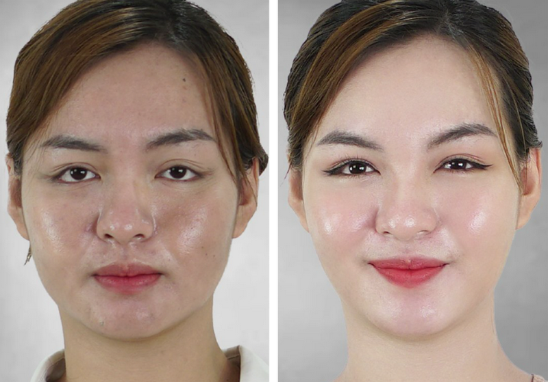 Tiêm BAP Jalupro giá bao nhiêu? Các yếu tố ảnh hưởng đến chi phí.