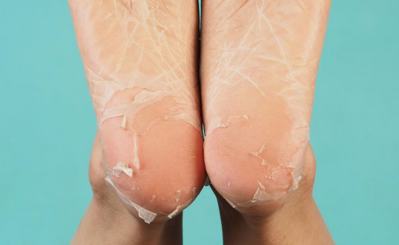 Peel da body là gì? Peel da toàn thân có an toàn không?