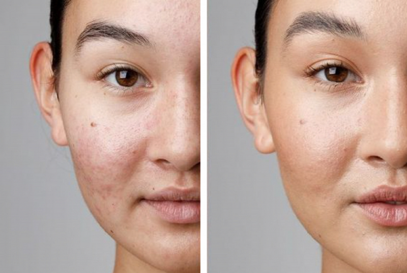 Peel da trị mụn được không? Cơ chế và quy trình kỹ thuật