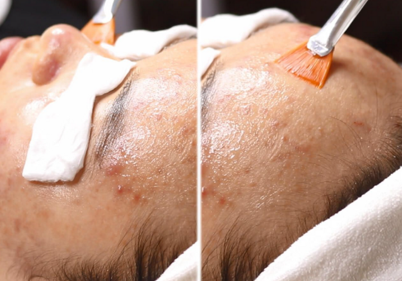 Peel da trị mụn được không? Cơ chế và quy trình kỹ thuật