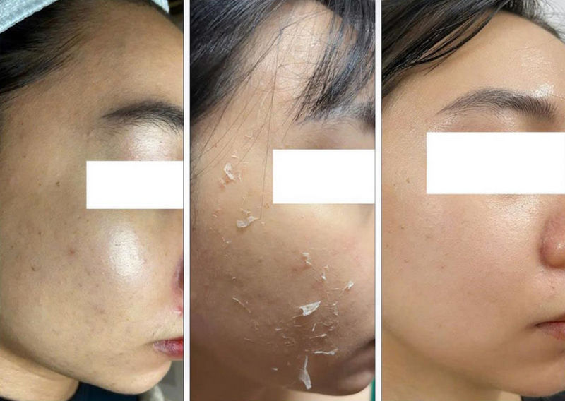 Peel da trị nám như thế nào? Cần lưu ý gì?
