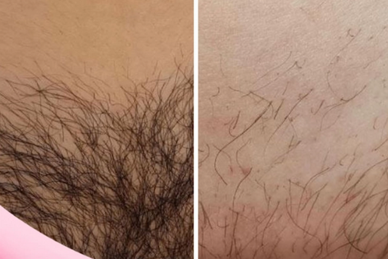 Cập nhật giá triệt lông bikini 2026