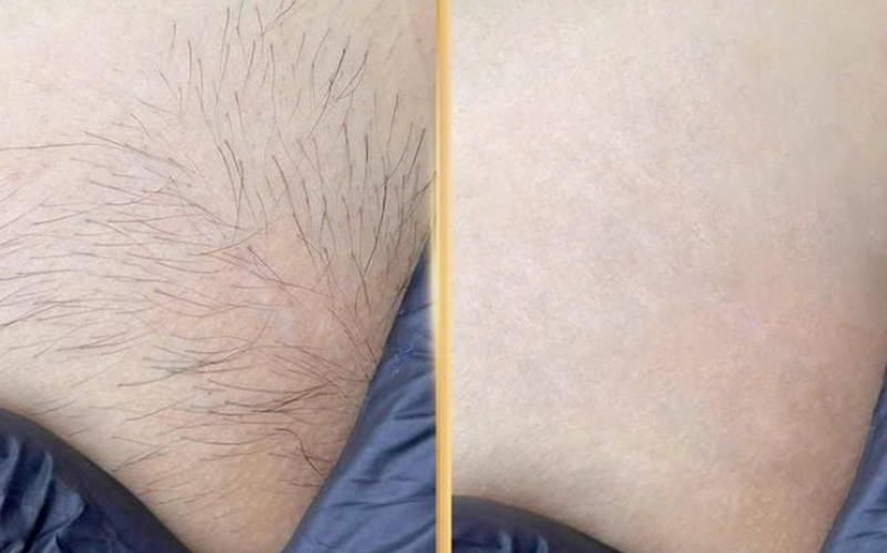 Triệt lông vùng kín nam có vĩnh viễn không? Phương pháp hiệu quả