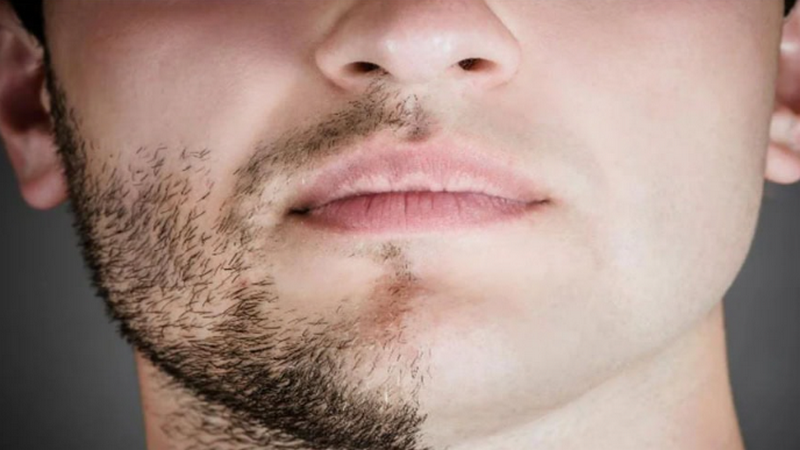 Triệt râu là gì? Các phương pháp triệt râu vĩnh viễn an toàn cho nam và nữ