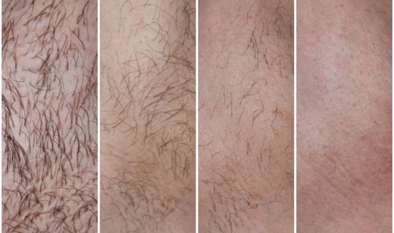 Triệt lông bikini tạo hình tự nhiên và an toàn