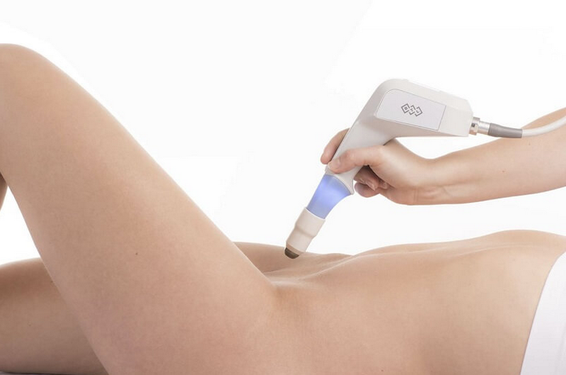 Triệt lông bikini tạo hình tự nhiên và an toàn