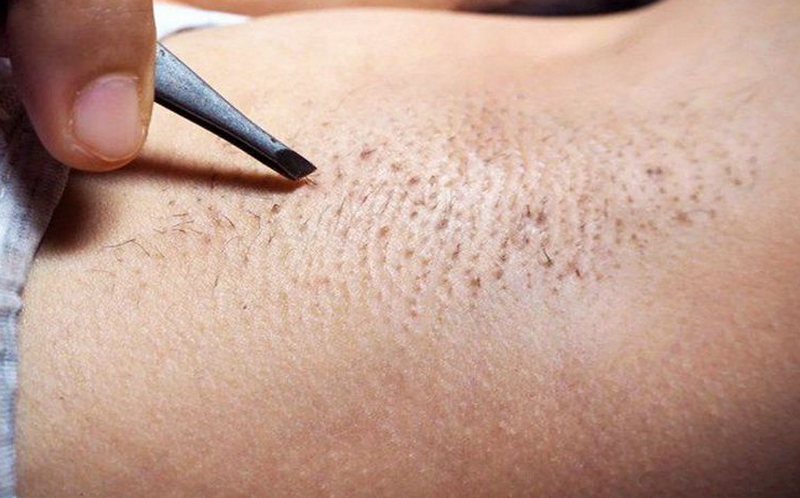 Lông nách có chức năng gì? Có nên triệt lông nách?