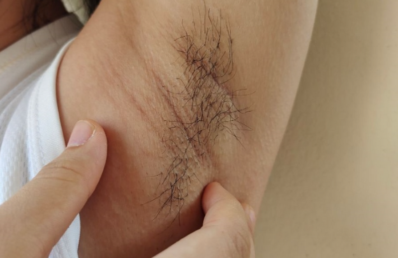 Lông nách có chức năng gì? Có nên triệt lông nách?