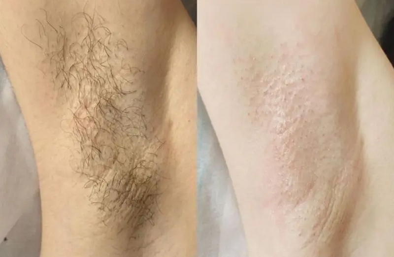 Giá triệt lông nách vĩnh viễn bao nhiêu? Những yếu tố quyết định chi phí
