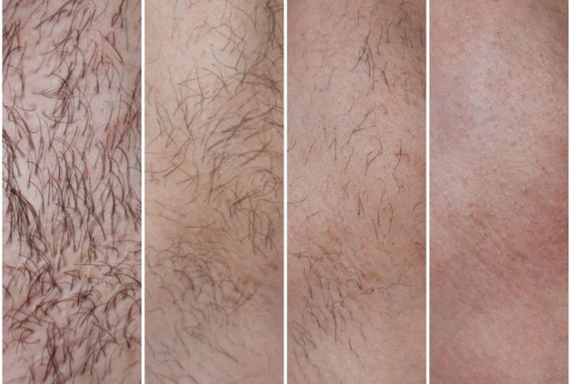 Mẹo triệt lông bikini tại nhà ít đau, tránh viêm da và thâm sạm