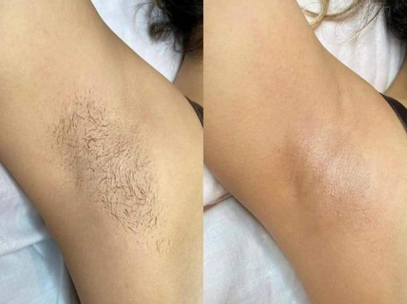 Kinh nghiệm triệt lông toàn thân an toàn, hạn chế kích ứng da