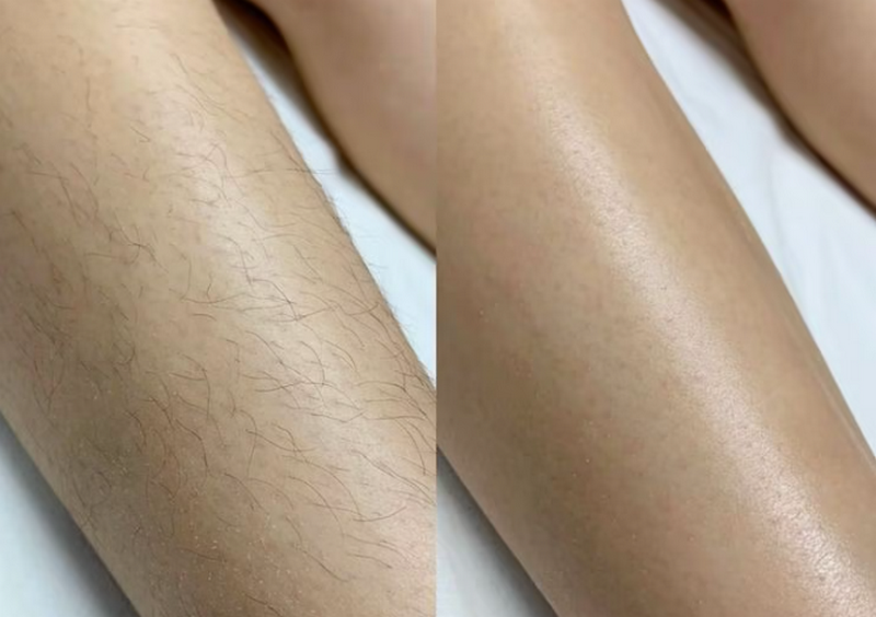 Kinh nghiệm triệt lông toàn thân an toàn, hạn chế kích ứng da