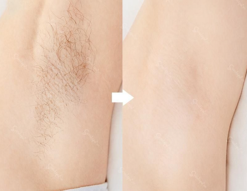 Bảng giá triệt lông vĩnh viễn tại spa, thẩm mỹ viện cập nhật mới nhất