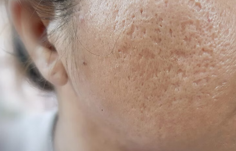 Cách trị sẹo hiệu quả: Nên chọn phương pháp nào cho từng loại sẹo?