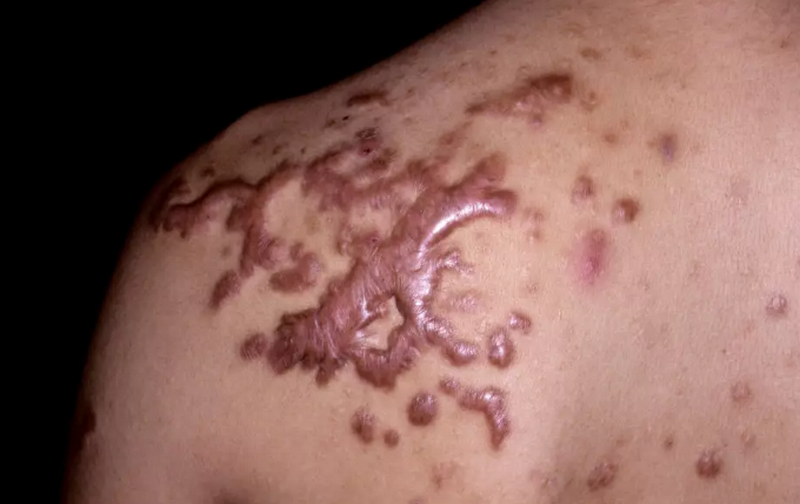 Cách trị sẹo hiệu quả: Nên chọn phương pháp nào cho từng loại sẹo?