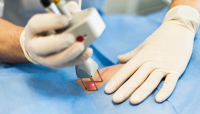 Cách trị sẹo: Phân loại sẹo & phương pháp phù hợp