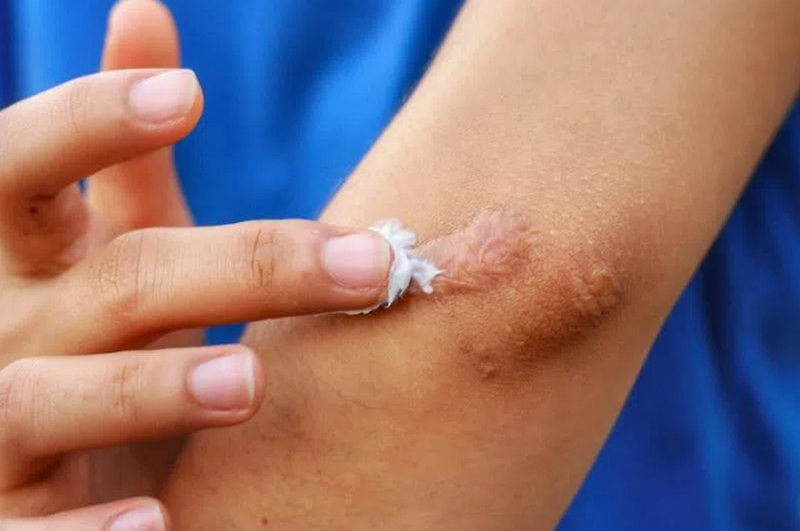 Cách trị sẹo hiệu quả: Nên chọn phương pháp nào cho từng loại sẹo?