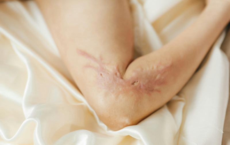 Sẹo lồi: Nguyên nhân, cách điều trị & khả năng tái phát bạn cần biết