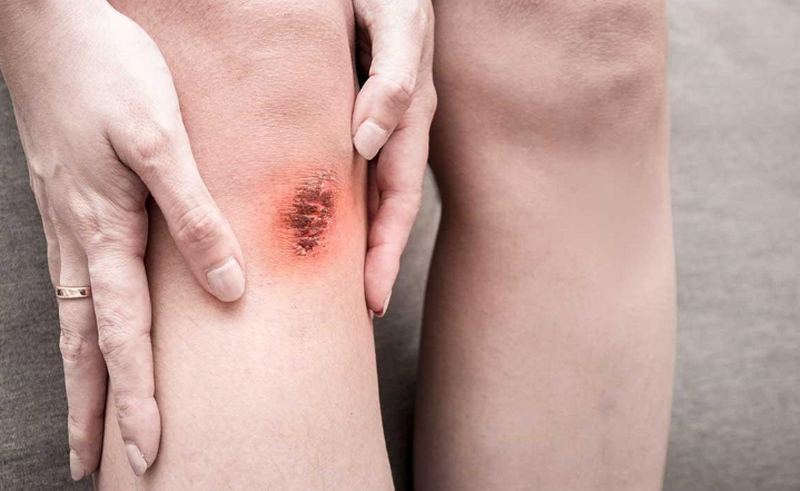 Quá trình hình thành sẹo lồi từ viêm đến rối loạn collagen