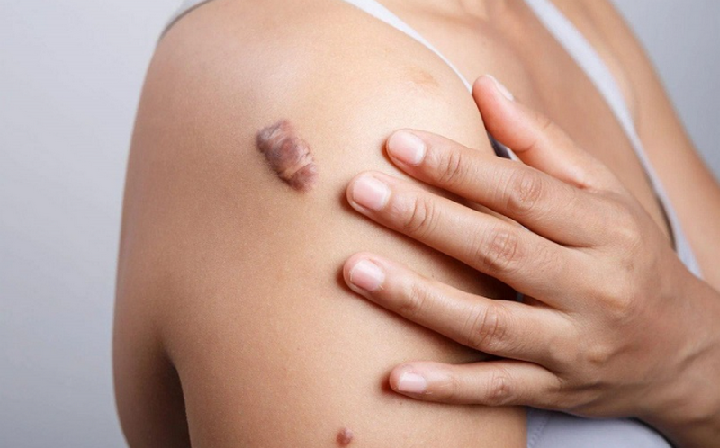 Sẹo lồi hình thành như thế nào? Cách điều trị và phòng ngừa hiệu quả