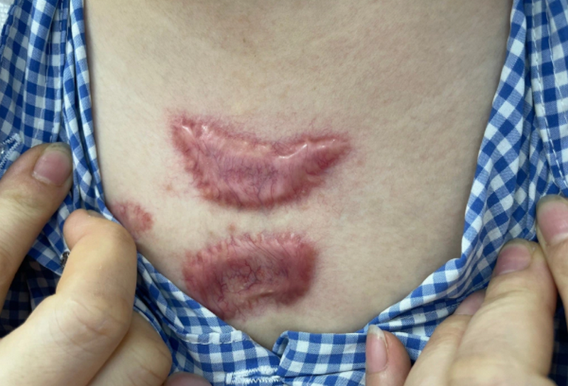 Mẹo chữa sẹo lồi dân gian có hiệu quả không? và những điều bạn cần biết