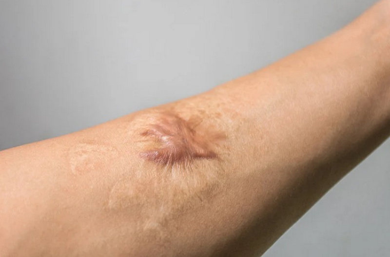 Cách trị sẹo lâu năm hiệu quả: Giải pháp cải thiện rõ rệt theo từng loại sẹo