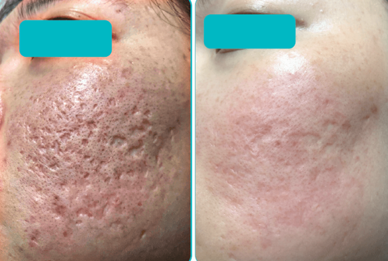 Cách trị sẹo lâu năm hiệu quả: Giải pháp cải thiện rõ rệt theo từng loại sẹo