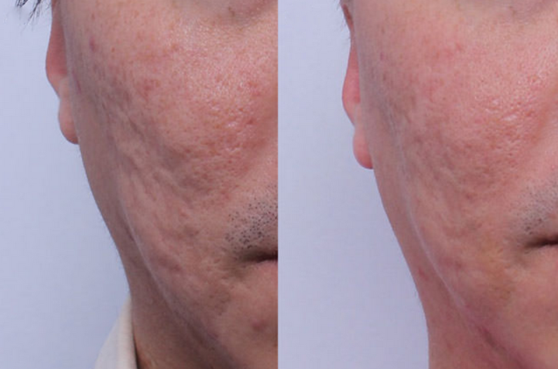 Trị sẹo lâu năm có hiệu quả không? Phương pháp và mức độ cải thiện